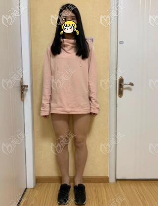 水動(dòng)力吸脂瘦大腿術(shù)前照 水動(dòng)力吸脂瘦大腿術(shù)前照