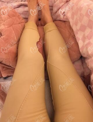 水動(dòng)力吸脂瘦大腿術(shù)后第1天照 水動(dòng)力吸脂瘦大腿術(shù)后第1天照