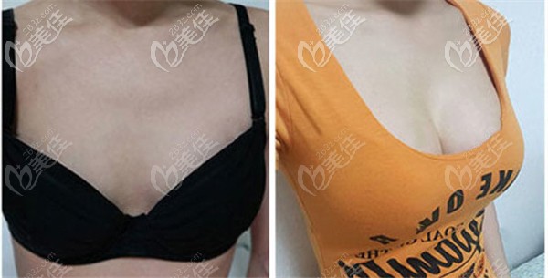 易東風醫(yī)生做脂肪豐胸的術(shù)前術(shù)后對比
