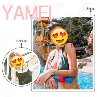 肖院長做自體脂肪隆胸案例