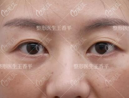 做劉志剛重瞼術(shù)術(shù)前照 做劉志剛重瞼術(shù)術(shù)前照