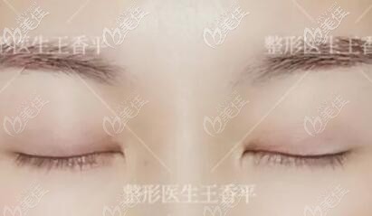 劉志剛重瞼術(shù)術(shù)后恢復(fù)好閉眼效果照 劉志剛重瞼術(shù)術(shù)后恢復(fù)好閉眼效果照