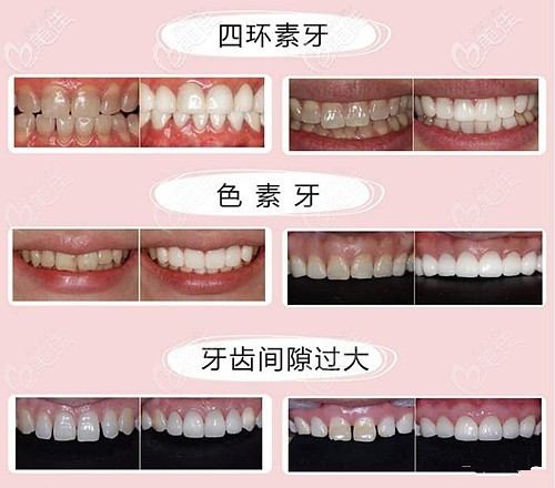 做冰瓷牙貼面前后效果對比