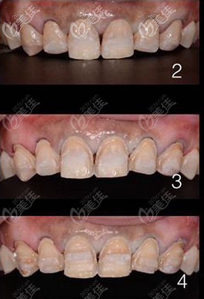 輕重程度不同的四環(huán)素牙