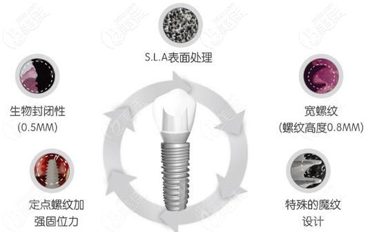 紐百特種植體的優(yōu)勢 紐百特種植體的優(yōu)勢