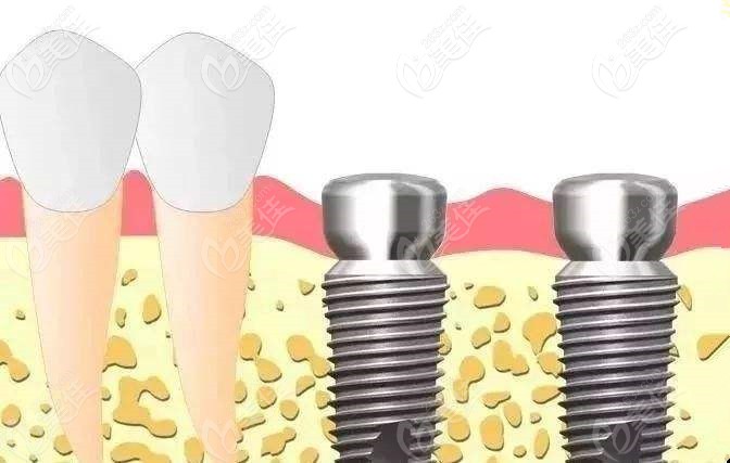 意大利BB種植體 意大利BB種植體
