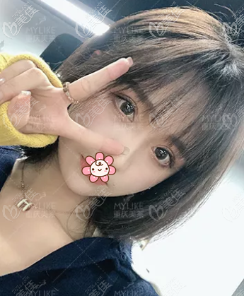 重慶美萊眼綜合術(shù)后3個(gè)月 重慶美萊眼綜合術(shù)后3個(gè)月