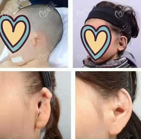 耳畸形不同程度做medpor耳再效果圖 耳畸形不同程度做medpor耳再效果圖