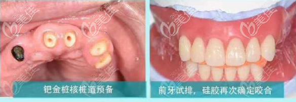 全口磁性附著體義齒打樁核并取模 全口磁性附著體義齒打樁核并取模