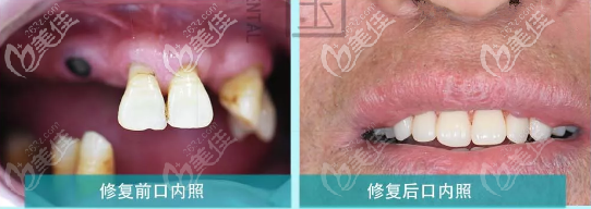 蘭州牙王國數(shù)字化口腔,全口磁性附著體義齒修復案例:多顆牙缺失不一定非要種植牙!