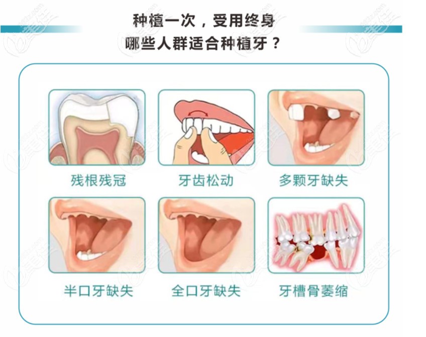 哪些人適合做種植牙 哪些人適合做種植牙