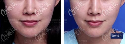30歲+做熱瑪吉提升緊致面部術(shù)前術(shù)后對(duì)比照 30歲+做熱瑪吉提升緊致面部術(shù)前術(shù)后對(duì)比照