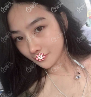 其實(shí)在去貴陽美萊做半肋軟骨鼻綜合前，我還面診過貴陽華美