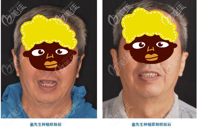 年過七旬的他飽受缺牙困擾，常州美奧用5顆諾貝爾cc做半口種植牙后，即刻就能咬甜瓜了