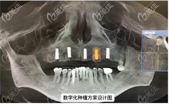羅醫(yī)生給秦先生設(shè)計的數(shù)字化種植方案設(shè)計圖 羅醫(yī)生給秦先生設(shè)計的數(shù)字化種植方案設(shè)計圖