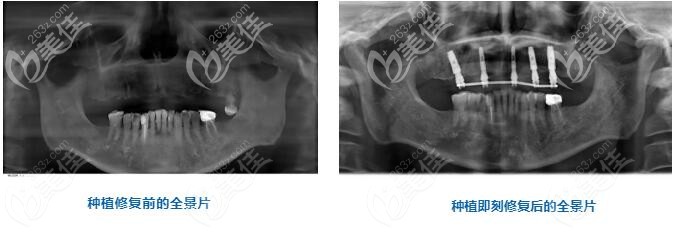 半口牙種植術(shù)后即刻全景片的對比 半口牙種植術(shù)后即刻全景片的對比