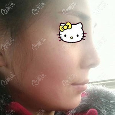 立秀加強型膨體隆鼻術后8天拆線