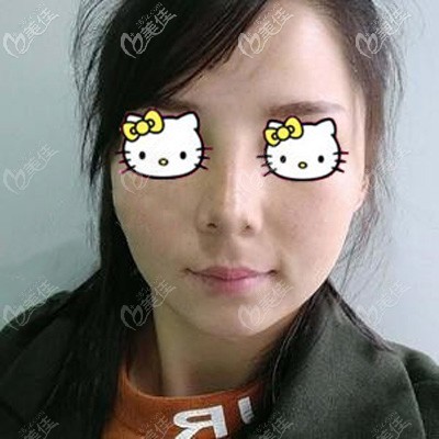 用立秀加強(qiáng)型膨體隆鼻后會(huì)不會(huì)鼻頭發(fā)硬？反正我去亳州締萊美做完后沒有