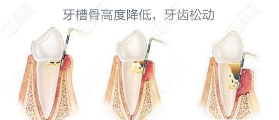 牙齒松動圖示 牙齒松動圖示