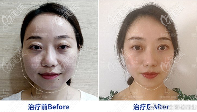 黃金微雕面部吸脂術(shù)前術(shù)后對比照 黃金微雕面部吸脂術(shù)前術(shù)后對比照