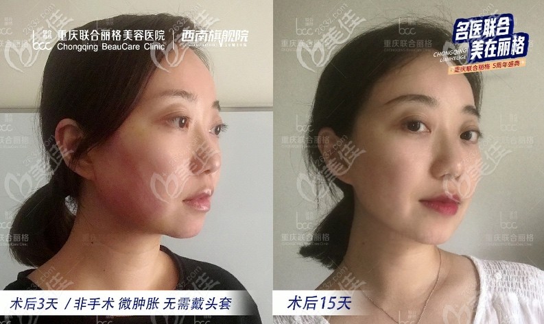 術(shù)后半個月左右 術(shù)后半個月左右