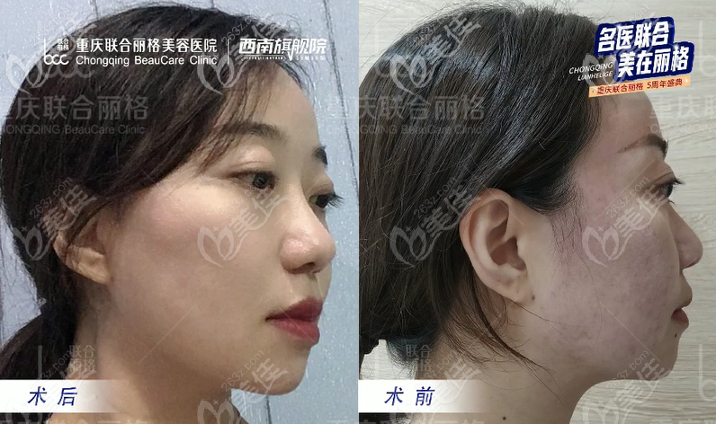 側(cè)面效果也很明顯 側(cè)面效果也很明顯