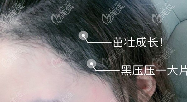 額角種植1800單位效果 額角種植1800單位效果