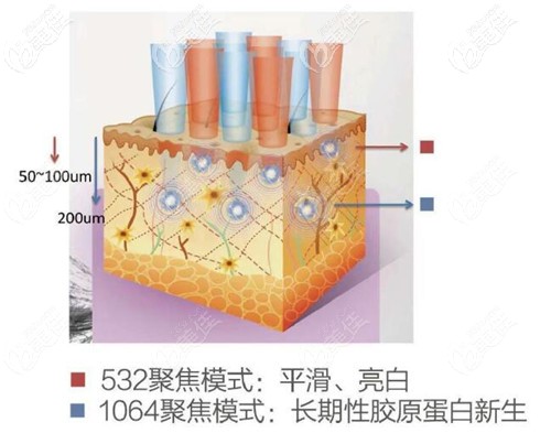 超皮秒祛黑頭的原理 超皮秒祛黑頭的原理