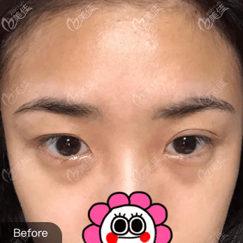 做內(nèi)切去眼袋前 做內(nèi)切去眼袋前