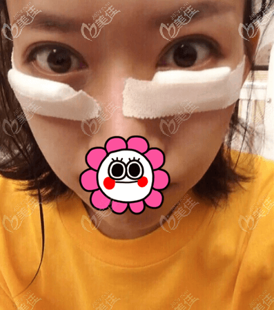 在北京童仁醫(yī)療美容做內(nèi)切祛眼袋術(shù)后頭一日樣子 在北京童仁醫(yī)療美容做內(nèi)切祛眼袋術(shù)后頭一日樣子