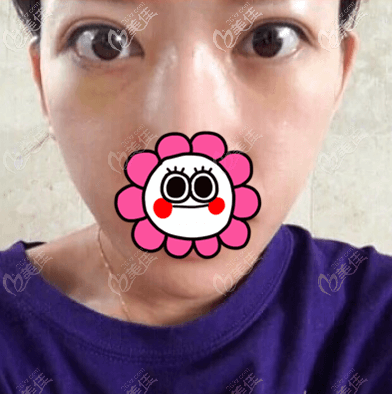 我做內(nèi)切祛眼袋第8天了 我做內(nèi)切祛眼袋第8天了