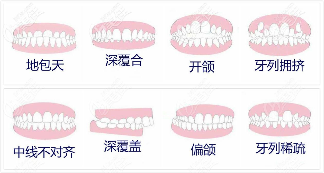 牙齒矯正適應(yīng)癥