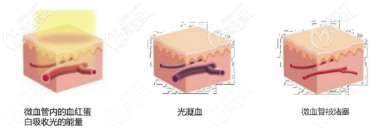 595染料激光Vbeam去除紅血絲的作用原理