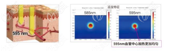 595nm波長(zhǎng)加熱血管的示意圖