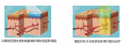 DCD動(dòng)態(tài)冷卻系統(tǒng)