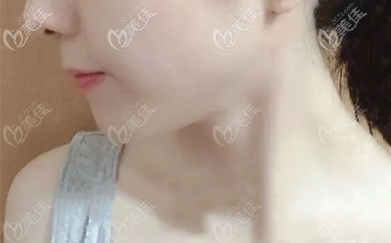 想來,當(dāng)初在廣州中家醫(yī)口腔矯正骨性加牙性齙牙的選擇是對(duì)的