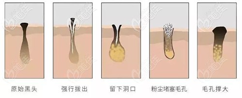 超皮秒去黑頭毛孔 超皮秒去黑頭毛孔