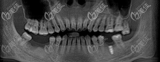 年輕人后牙缺失怎么辦 年輕人后牙缺失怎么辦