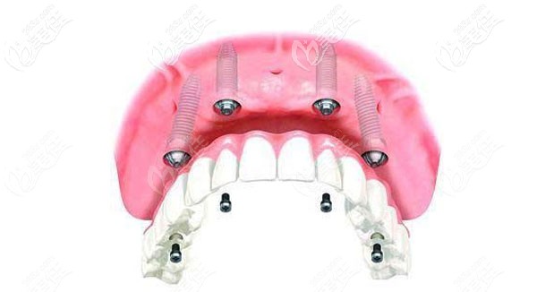 all-on-4種植牙的優(yōu)勢大于弊端