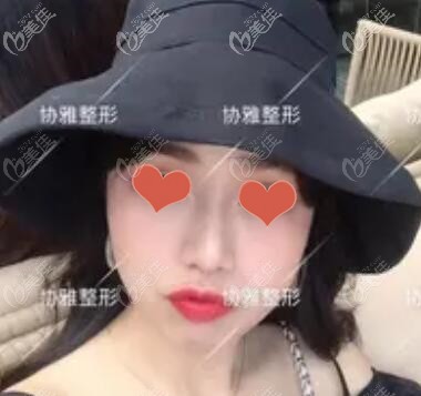 找鄒笑寒做進(jìn)口硅膠假體+耳軟骨鼻綜合有2個(gè)多月了，來(lái)看下效果怎么樣