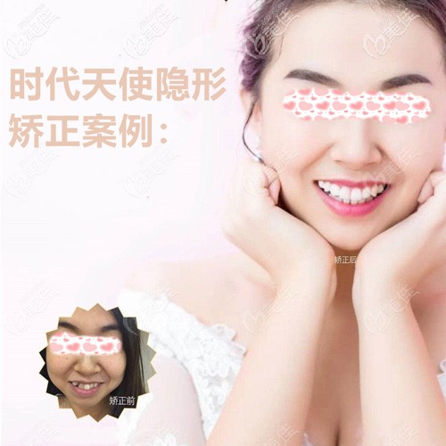 千辛萬苦找到的太原眾牙時(shí)代天使隱形矯正案例，你不看看嗎