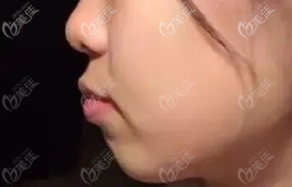 骨性齙牙矯正前的照片 骨性齙牙矯正前的照片