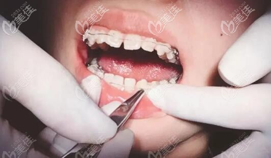 骨性齙牙戴半隱形陶瓷托槽的照片 骨性齙牙戴半隱形陶瓷托槽的照片