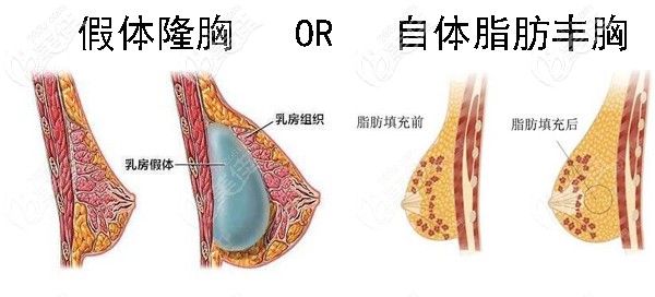 硅膠假體隆胸好還是自體脂肪豐胸好