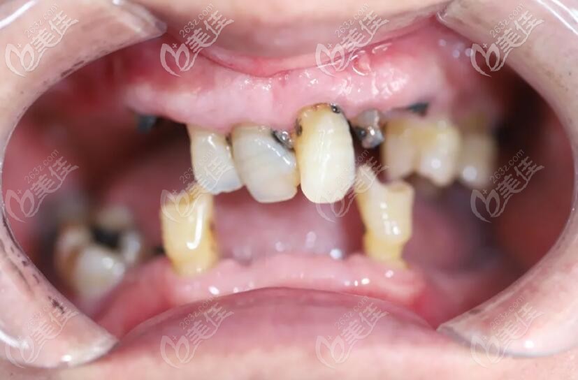 這樣的牙齒狀況說是七八十歲的老人也不為過 這樣的牙齒狀況說是七八十歲的老人也不為過