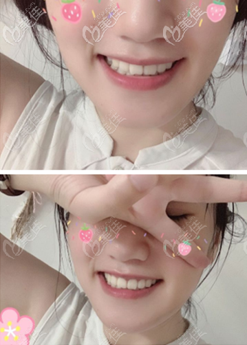 骨性齙牙矯正案例：自鎖金屬托槽和非自鎖區(qū)別挺大，我選了前面