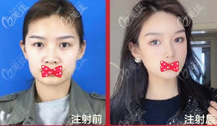 白鵬麗醫(yī)生注射玻尿酸除皺案例