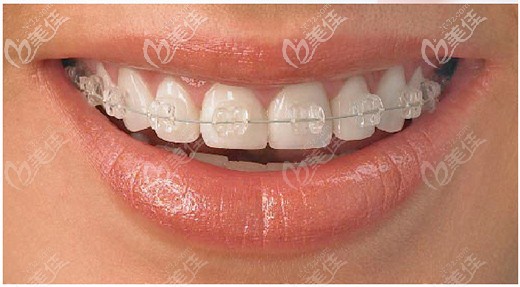 陶瓷半隱形矯正優(yōu)勢圖