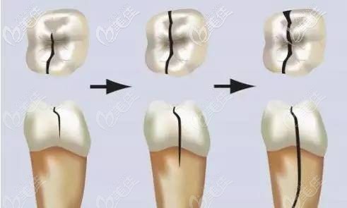 牙齒齲壞的過(guò)程