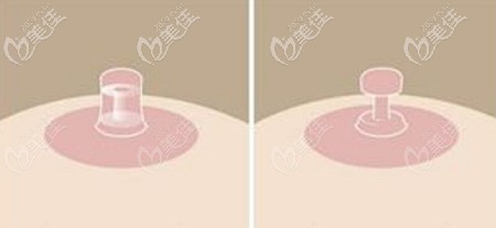 環(huán)形乳頭縮小手術的原理 環(huán)形乳頭縮小手術的原理